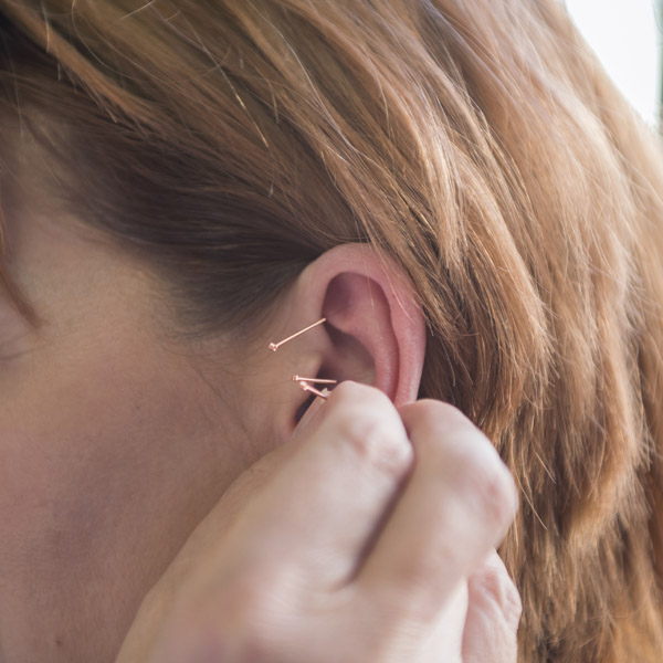 EAR ACUPUNCTURE